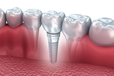 dental-implants201712