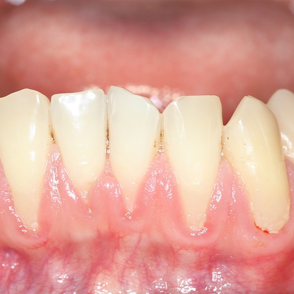 Gingival recession, also known as receding gums