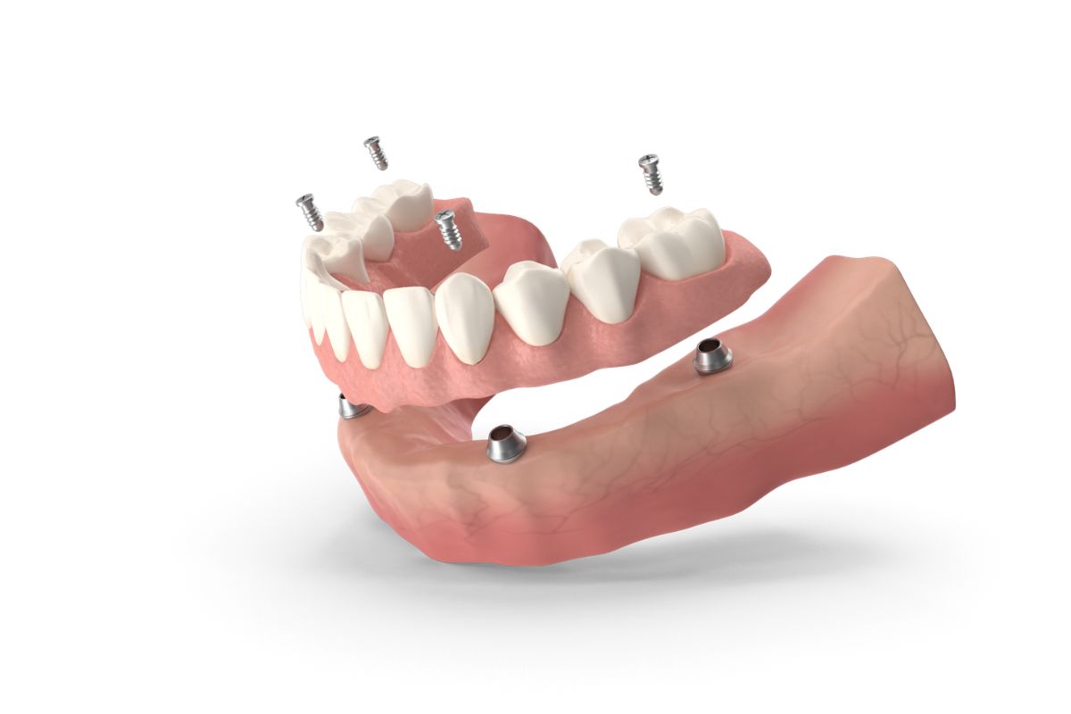 all on x implants graphics all on x implants graphics