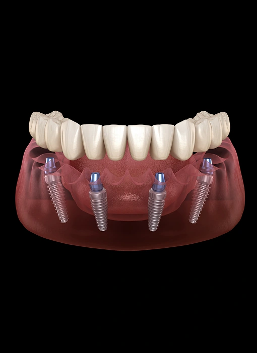 img-all-on-x-dental-implants (1) Illustration of All-on-4 dental implants supporting a full arch of replacement teeth in the lower jaw